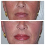 Permanent Make up Lippe mit voll Schattierung direkt nach der Behandlung